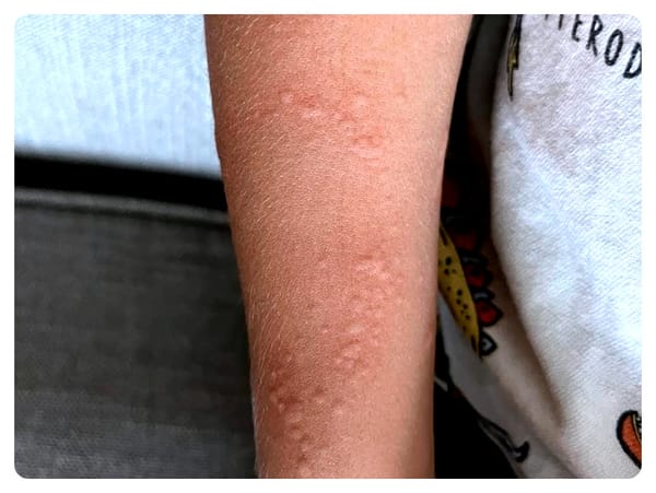 Alergia en niños: Picaduras de Insectos